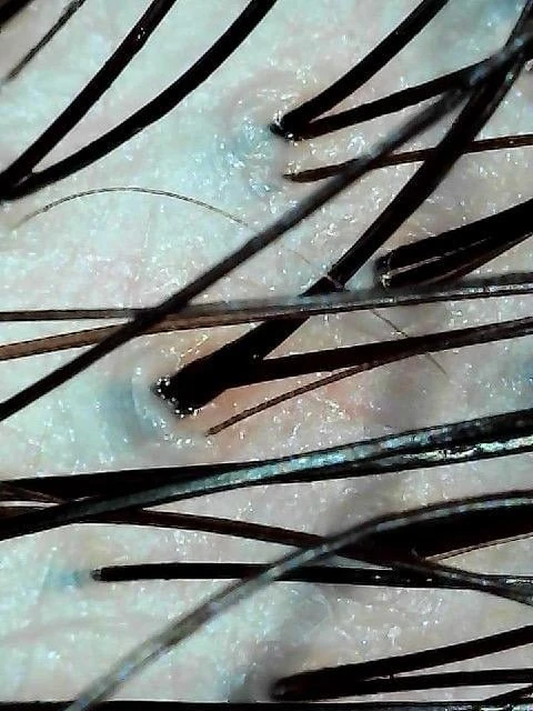 Scalp therapy